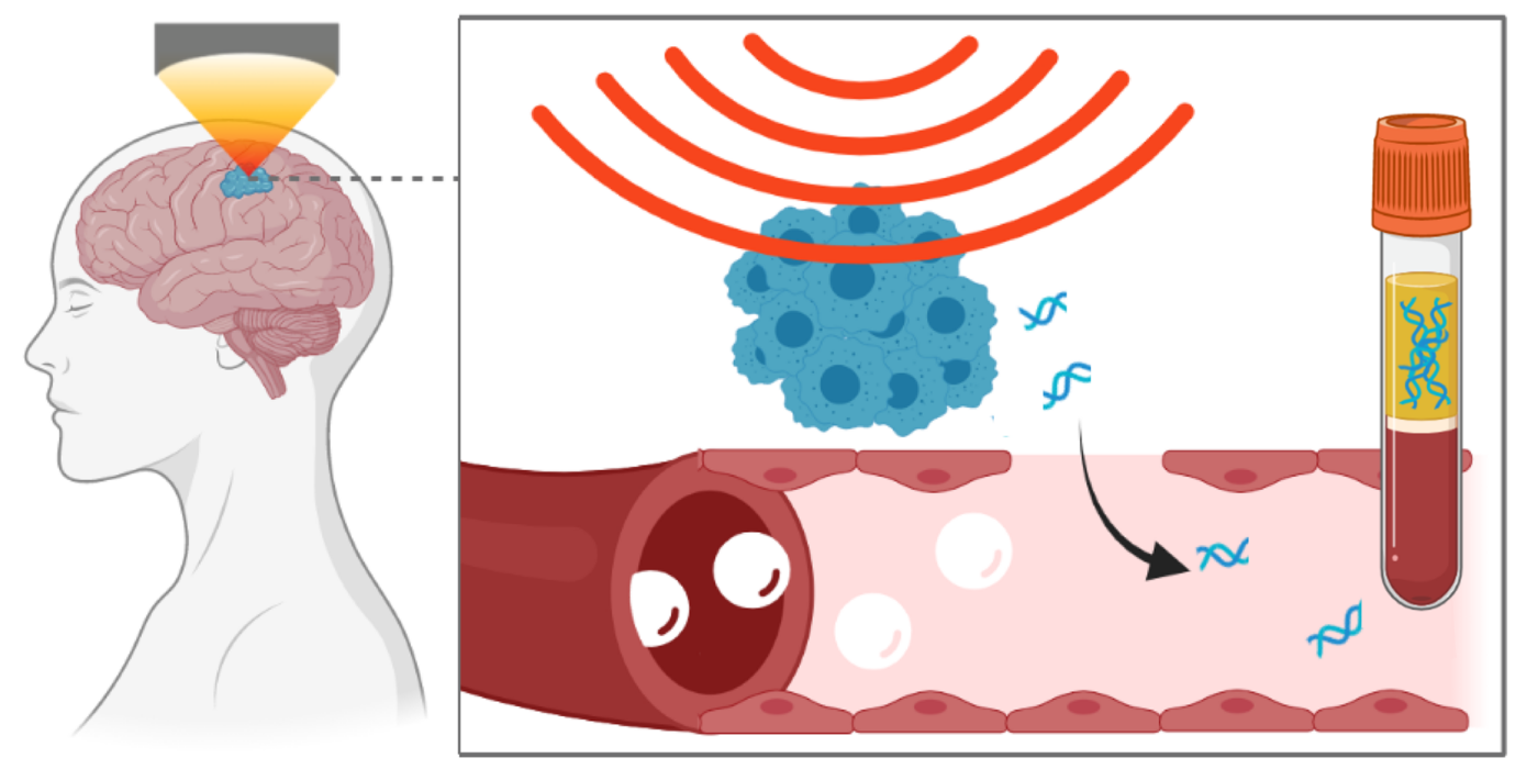 Focused ultrasound technique leads to release of neurodegenerative disorders biomarkers